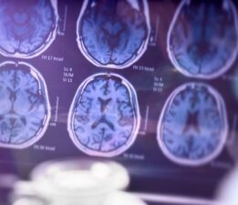 Uçuk virüsü beyni nasıl tehdit ediyor? Alzheimer’ı tetikliyor mu?